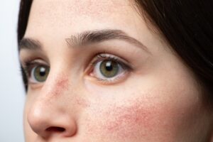 Bij Sarah J in Bree bieden we een behandeling voor tegen Couperose rosacea